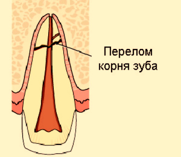 Продольный перелом зуба фото