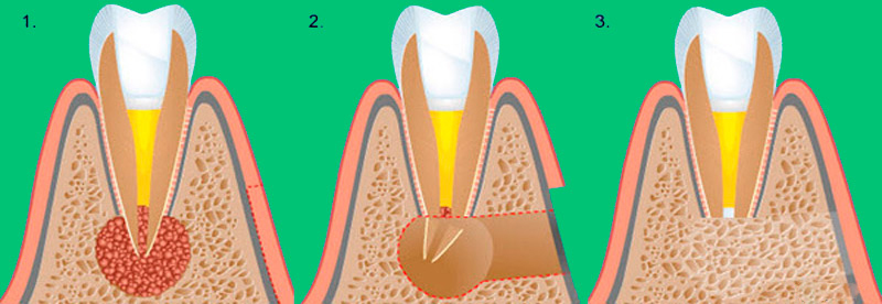 Резекция верхшки корня зуба