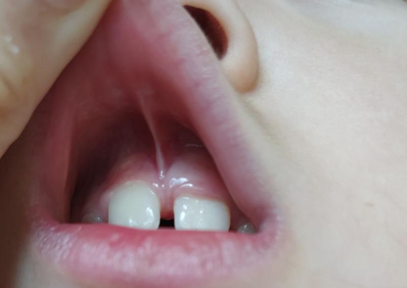 Пластика уздечки верхней и нижней губы